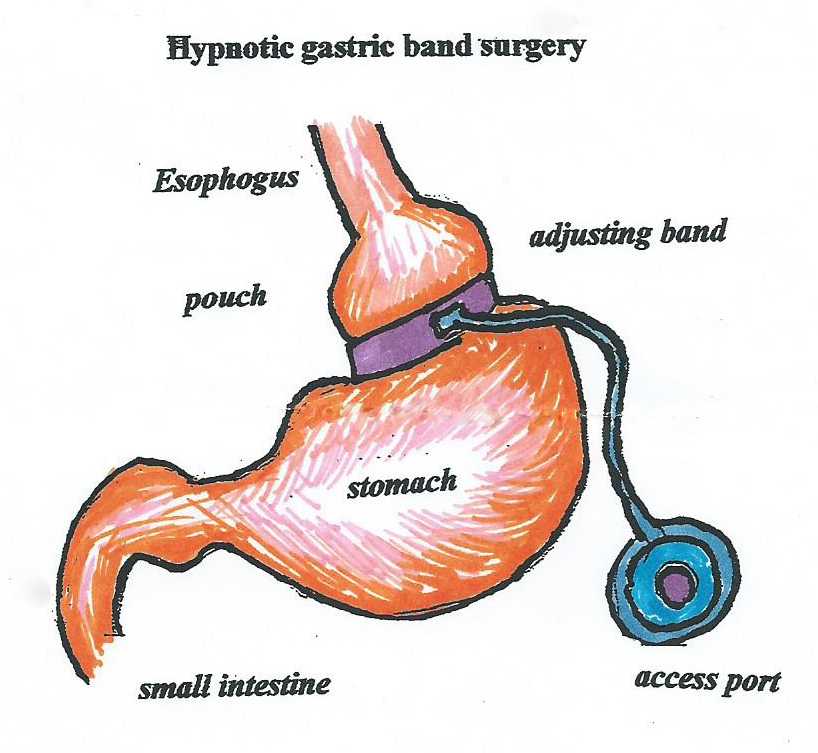 gastric band surgery